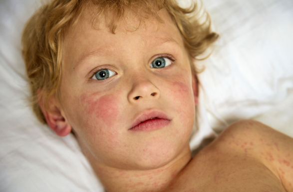 Measles Has Killed a Child in Texas, Misinformation Will Kill Many More ...